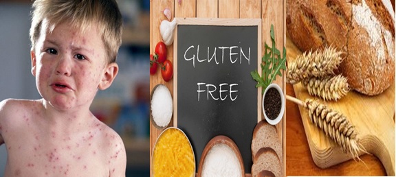 ÇÖLYAK DIŞI GLUTEN DUYARLILIĞI, BUĞDAY VE GLUTEN ALERJİSİ, ÇÖLYAK HASTALIĞI